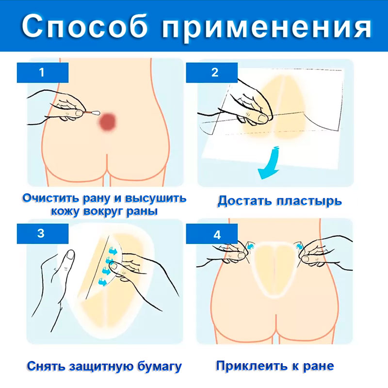 Пластырь противопролежневый для копчика