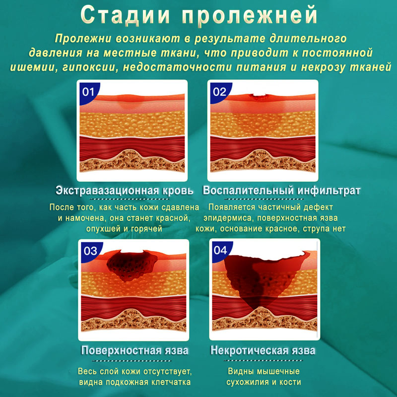 Стадии пролежней