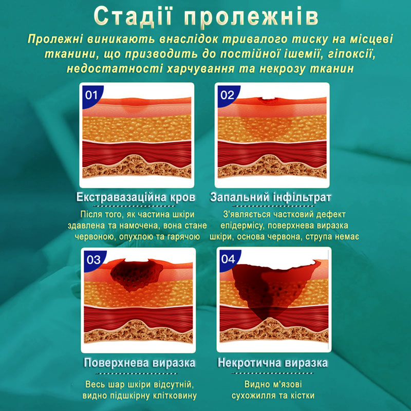 Стадії пролежнів