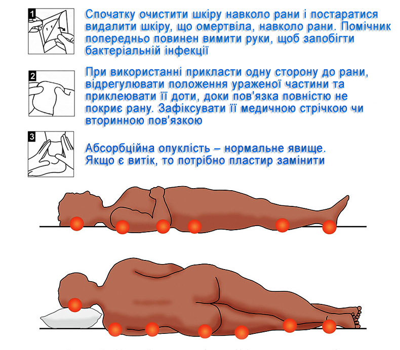 Альгінатна пов'язка