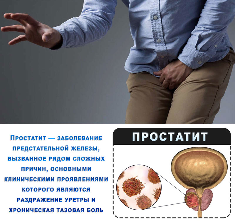 Урологический китайский пластырь от простатита
